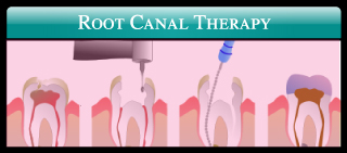 Root Canal Therapy
